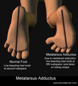 metatarsus adductus classification