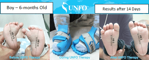 Results of Metatarsus Adductus due to Unfo med sandal
