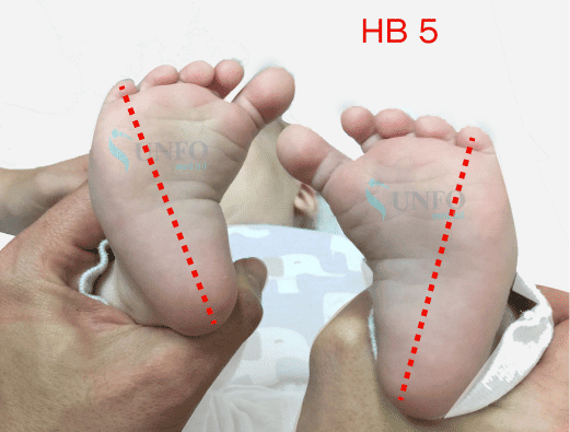 Newborn Feet: Common Deformities 