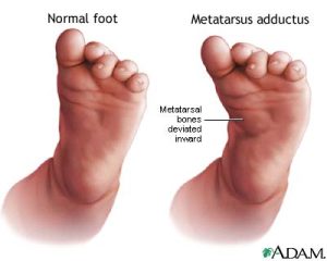 Metatarsus adductus in infants